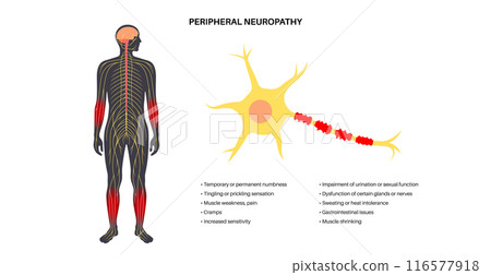 Peripheral neuropathy medical poster 116577918