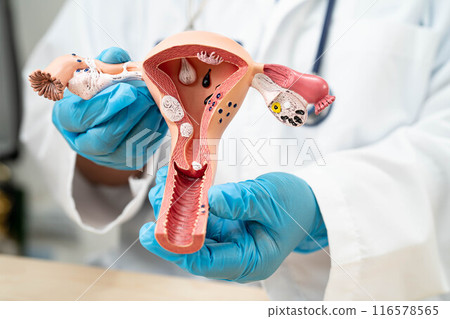 Uterus, doctor with anatomy model for study diagnosis and treatment in hospital. Uterus, doctor with anatomy model for study diagnosis and treatment in hospital. 116578565