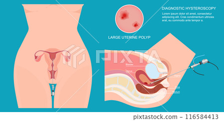 Diagnostic hysteroscopy is a minimally invasive procedure called a hysteroscope. Diagnostic hysteroscopy is a minimally invasive procedure called a hysteroscope. 116584413