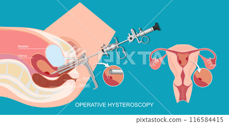 Operative hysteroscopy is a minimally invasive gynecological procedure. 116584415