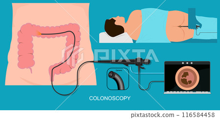 Colonoscopy is an exam used to look for changes. 116584458