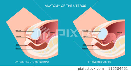 An anteverted uterus different than a retroverted uterus. 116584461