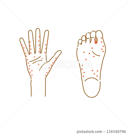 經常出現汗水泡的區域的圖像插圖集（手和腳底） 116588790