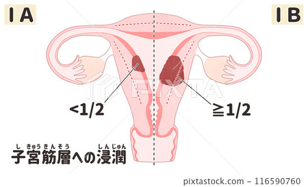 子宮癌I期（第1期） 簡單易懂的日文插圖 116590760