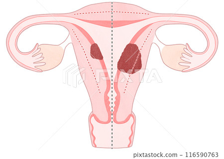 Stage I (1st stage) uterine cancer - easy-to-understand illustration 116590763