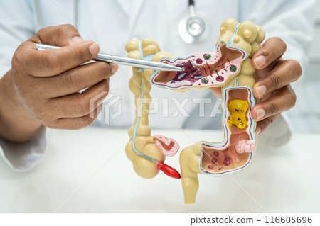 Intestine, appendix and digestive system, doctor holding anatomy model for study diagnosis and treatment in hospital. 116605696