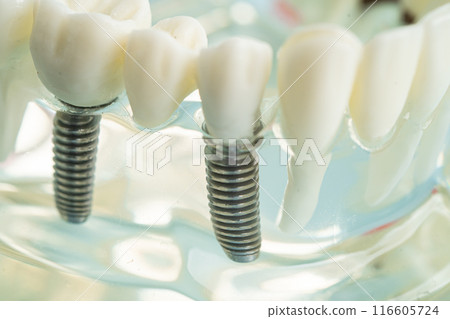 Dental implant, artificial tooth roots into jaw, root canal of dental treatment, gum disease, teeth model for dentist studying about dentistry. Dental implant, artificial tooth roots into jaw, root canal of dental treatment, gum disease, teeth model for dentist studying about dentistry. 116605724