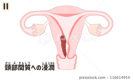 Stage II (2nd stage) uterine cancer - easy-to-understand Japanese illustrations 116614954