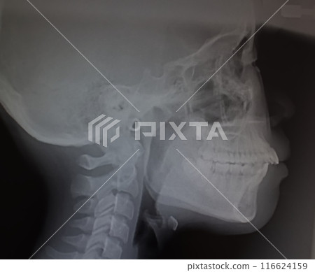 X 光照片 頭影測量 頭部 X 光標準照片 牙科影像 X 光照片 頭影測量 頭部 X 光標準照片 牙科影像 116624159