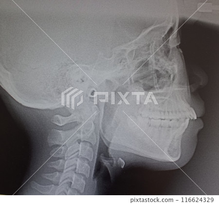X-ray photograph, cephalometric, standard head x-ray photograph, dental image 116624329