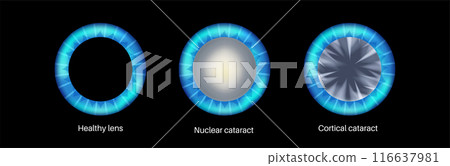 Cataract eye disease 116637981