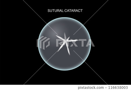 Cataract eye disease 116638003