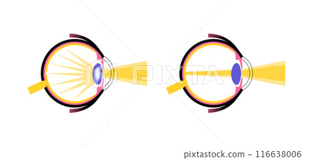 Cataract eye disease 116638006