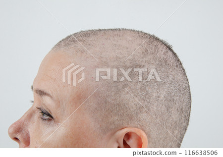 Survivor's Strength: Intimate Profile of a Woman's Scalp Post-Chemotherapy, Capturing Her Fight Against Cancer. 116638506