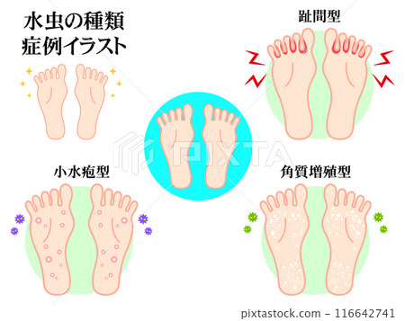 簡單的腳氣案例插畫素材集 簡單的腳氣案例插畫素材集 116642741