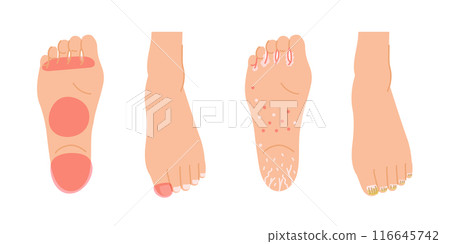 A set of illustrations of areas where athlete's foot often occurs (soles of the feet and toenails) A set of illustrations of areas where athlete's foot often occurs (soles of the feet and toenails) 116645742