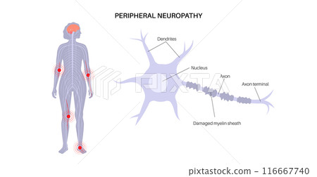 Peripheral neuropathy medical poster Peripheral neuropathy medical poster 116667740