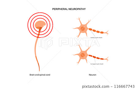 Peripheral neuropathy medical poster Peripheral neuropathy medical poster 116667743
