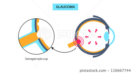 Damaged optic cup Damaged optic cup 116667744