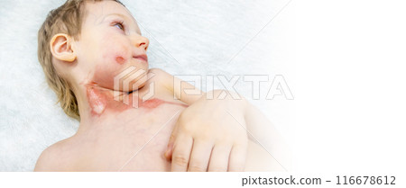 dressing a boy with a burn from boiling water 116678612