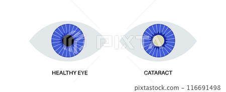 Cataract eye disease 116691498