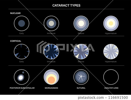 Cataract eye disease 116691500