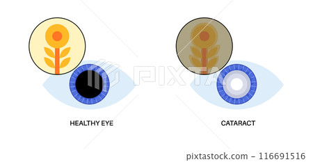 Cataract eye disease 116691516