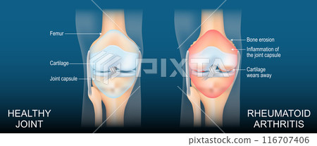 Rheumatoid arthritis 116707406