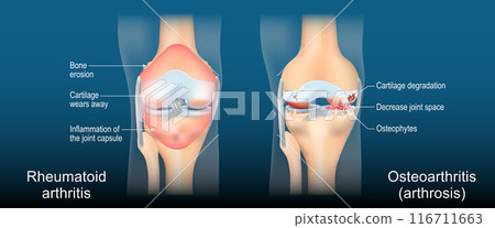 Rheumatoid arthritis and Osteoarthritis. Comparison between a Arthrosis and  RA joints 116711663