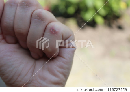 A callus on a finger close-up. Hands that require care A callus on a finger close-up. Hands that require care 116727359