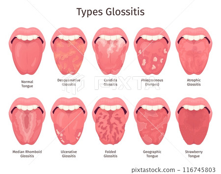 Glossitis. Scarlet tongue disease types, human mouth sore teeth problem healthy or sick xerostomia thrush atrophic candidiasis bacteria infections ulcera swanky illustration Glossitis. Scarlet tongue disease types, human mouth sore teeth problem healthy or sick xerostomia thrush atrophic candidiasis bacteria infections ulcera swanky illustration 116745803