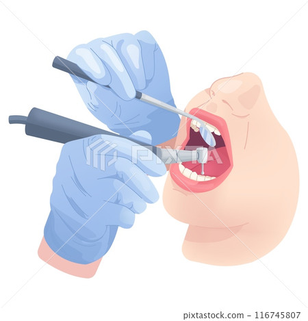 Dentist hands drill teeth. Dental surgery, stomatologist hands in sterile gloves with medical tool cleaning open mouth patient, dentistry teeth treatment swanky illustration 116745807