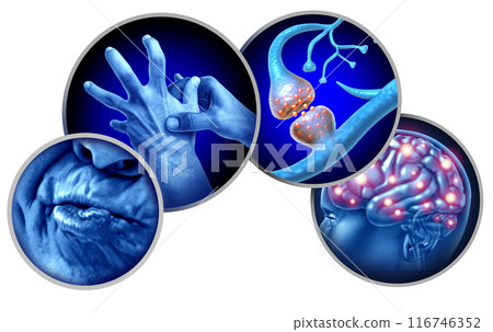 Tardive Dyskinesia TD 116746352