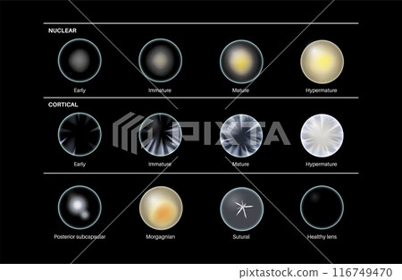 Cataract eye disease 116749470