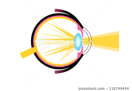 Cataract eye disease 116749484