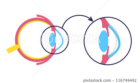 Cataract eye disease Cataract eye disease 116749492