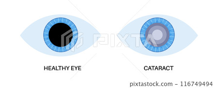 Cataract eye disease 116749494