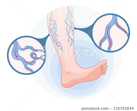 Varicose veins. Blue blood vessel visible through the skin, abnormally swollen leg. Vascular disease diagnostic and treatment. Venous insufficiency medical disease Varicose veins. Blue blood vessel visible through the skin, abnormally swollen leg. Vascular disease diagnostic and treatment. Venous insufficiency medical disease 116763644