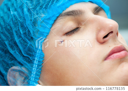 Close up of a young male patient face after a benign skin lesion removal at dermatologist office. 116778135