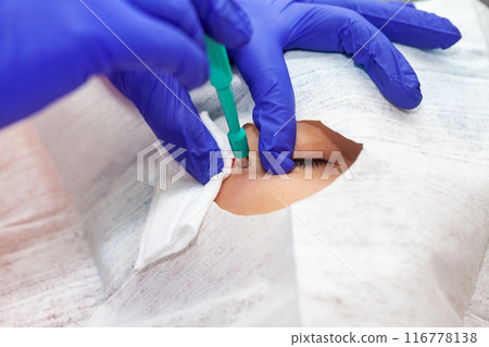 Skin lesion removal procedure. Dermatologist carrying out a removal of benign skin lesion on the face of a young male patient. 116778138