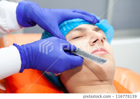 Skin lesion removal procedure. Dermatologist carrying out a removal of benign skin lesion on the face of a young male patient. 116778139
