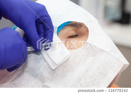 Skin lesion removal procedure. Dermatologist carrying out a removal of benign skin lesion on the face of a young male patient. 116778142