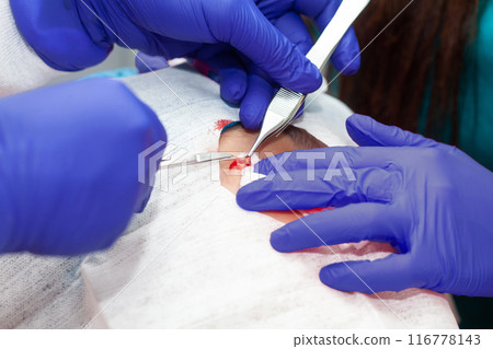 Skin lesion removal procedure. Dermatologist carrying out a removal of benign skin lesion on the face of a young male patient. 116778143