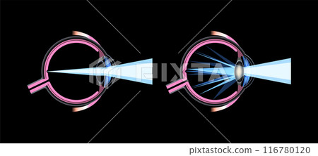Cataract eye disease 116780120