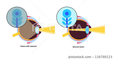 Cataract eye disease 116780123