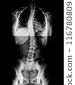X-ray of idiopathic S-shaped scoliosis of thoracic and lumbar spine. Part of skeleton with spinal curvature on black background. Lateral backbone deformation. Radiological image of back and pelvis 116780809
