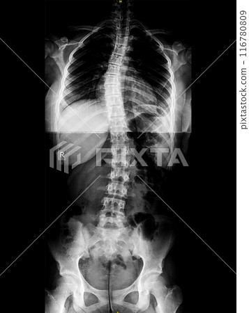 X-ray of idiopathic S-shaped scoliosis of thoracic and lumbar spine. Part of skeleton with spinal curvature on black background. Lateral backbone deformation. Radiological image of back and pelvis 116780809
