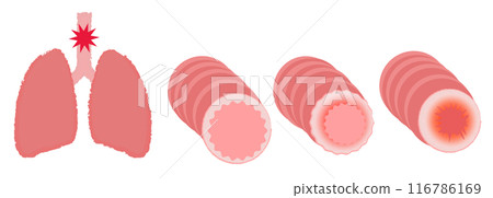 Illustration of bronchi and lungs asthma disease image 116786169