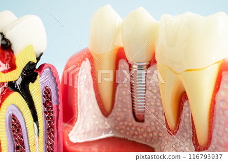 Dental implant, artificial tooth roots into jaw, root canal of dental treatment, gum disease, teeth model for dentist studying about dentistry. Dental implant, artificial tooth roots into jaw, root canal of dental treatment, gum disease, teeth model for dentist studying about dentistry. 116793937