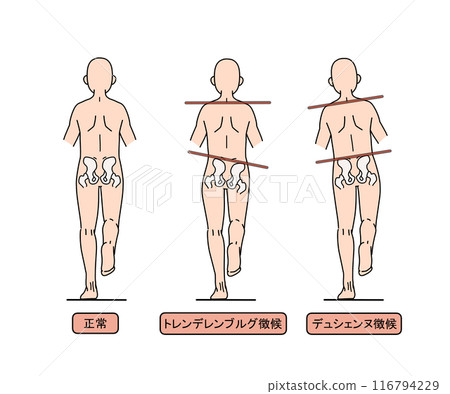 Trendelenburg's sign and Ducienne's sign (with text) Trendelenburg's sign and Ducienne's sign (with text) 116794229